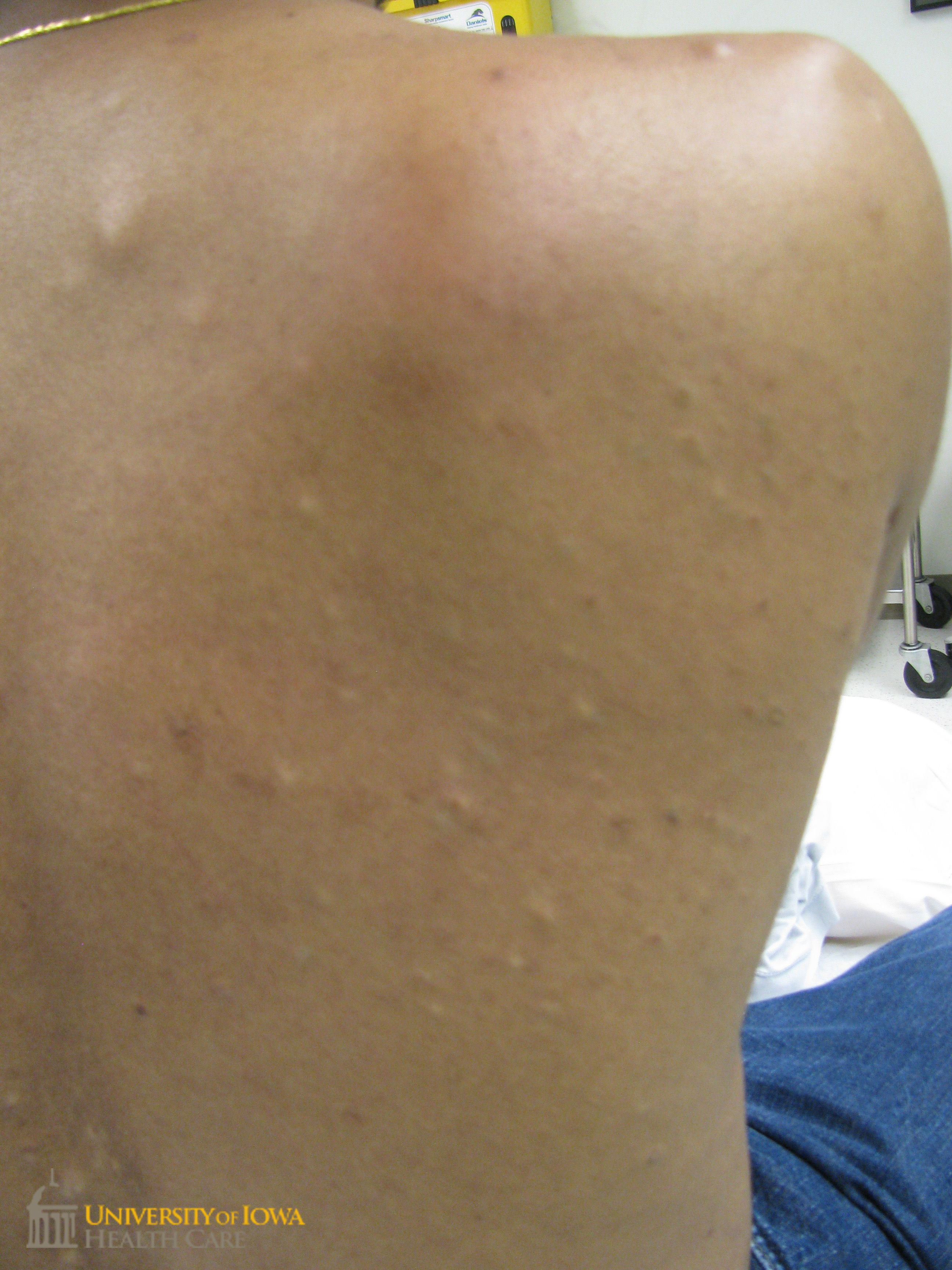 Multiple gray and yellow papules on the trunk. (click images for higher resolution).